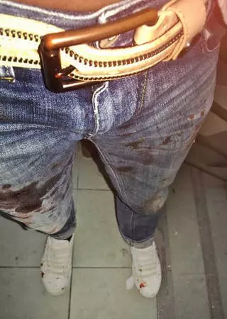 夜店遭三男圍毆濺血 胡問遂鼻樑骨折須整形