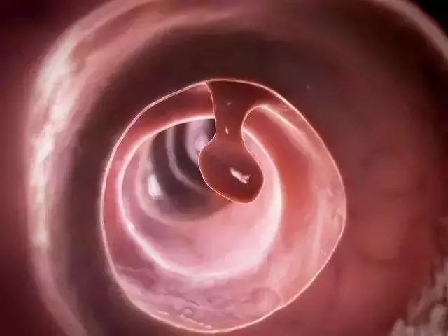 「息肉」離癌症有多遠?腫瘤專家:「趴」著的息肉最危險
