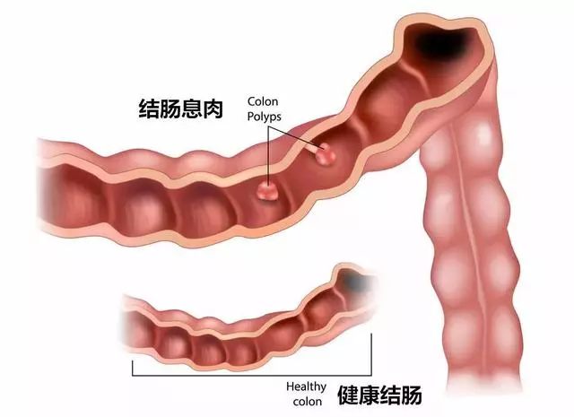 「息肉」離癌症有多遠?腫瘤專家:「趴」著的息肉最危險