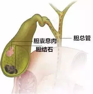 「息肉」離癌症有多遠?腫瘤專家:「趴」著的息肉最危險