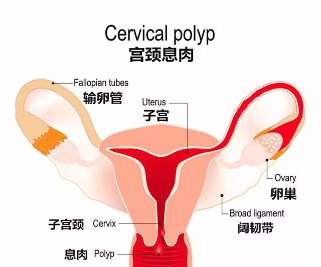 「息肉」離癌症有多遠?腫瘤專家:「趴」著的息肉最危險