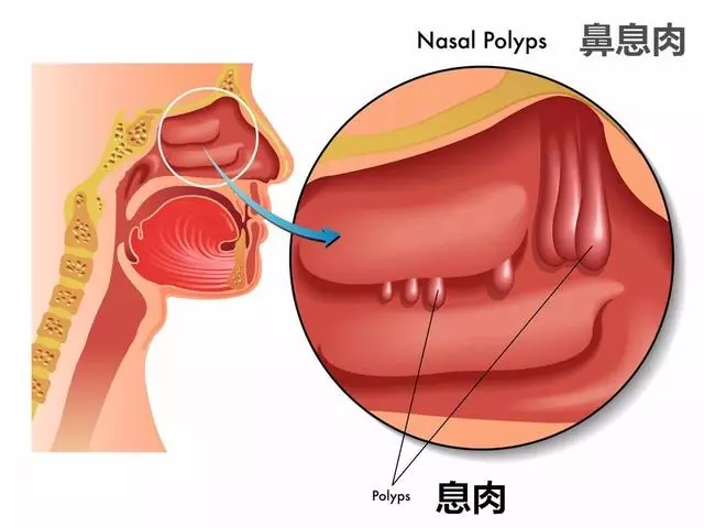 「息肉」離癌症有多遠?腫瘤專家:「趴」著的息肉最危險