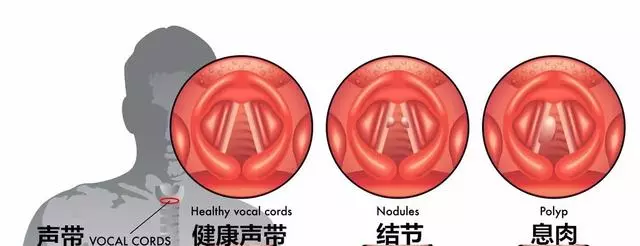 「息肉」離癌症有多遠?腫瘤專家:「趴」著的息肉最危險