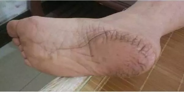 手腳裂口、中老年人便秘、感冒咳嗽、肩周炎等等,老中醫教你一招,3天就見效~(為爸媽收藏起來!)