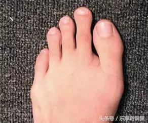 腎臟不好,耳朵會有3個表現,如果你沒有,說明腎臟比較健康