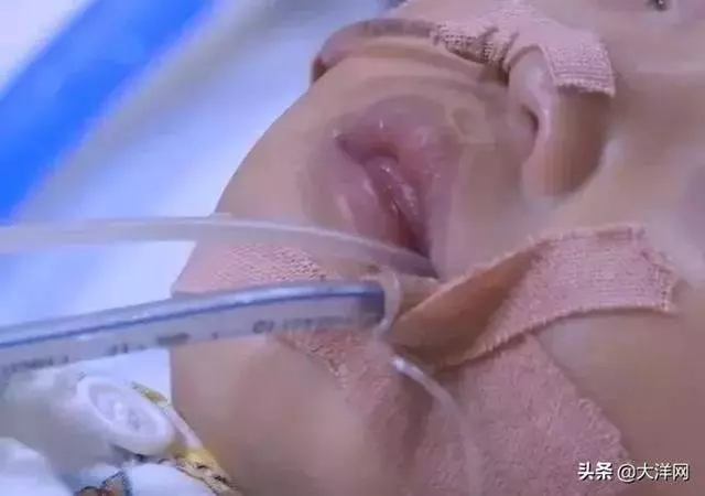 @所有家長:因為吃這個水果,1歲男孩心臟停跳40多分鐘