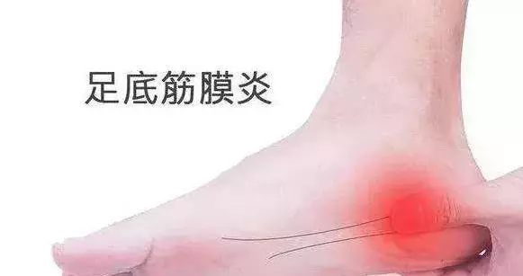 走路腳跟疼,像踩到釘子一樣疼?教你4招,迅速止疼,遠離足底筋膜炎