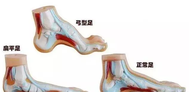 走路腳跟疼,像踩到釘子一樣疼?教你4招,迅速止疼,遠離足底筋膜炎