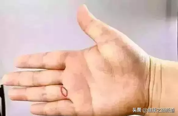 【捏捏手指,簡單預防7大疾病!】
