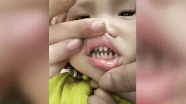 寶寶天生長一副鯊魚牙齒,親友笑:你兒子有貴族血統,網友卻說:這父母太缺德