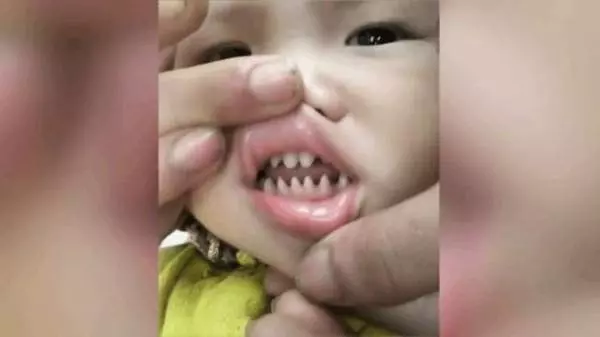 寶寶天生長一副鯊魚牙齒,親友笑:你兒子有貴族血統,網友卻說:這父母太缺德