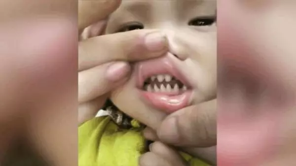 寶寶天生長一副鯊魚牙齒,親友笑:你兒子有貴族血統!網友卻說:這父母太缺德!