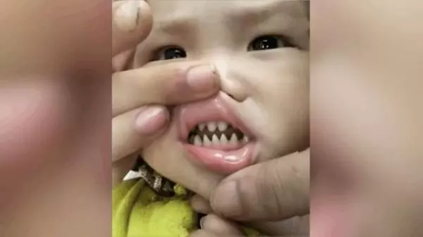 寶寶天生長一副鯊魚牙齒,親友笑:你兒子有貴族血統!網友卻說:這父母太缺德!