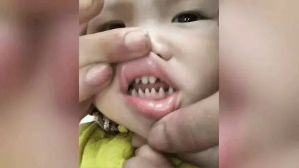 寶寶天生長一副鯊魚牙齒,親友笑:你兒子有貴族血統!網友卻說:這父母太缺德!