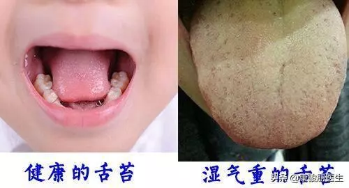 濕氣重看舌頭!3個食物要少吃,按3個穴位,濕氣沒了一身輕鬆!