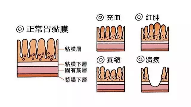 胃病總是反反覆復?消化科醫生手把手教你如何養胃丨腸胃專題