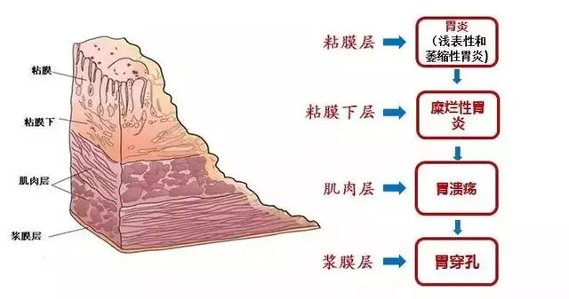 胃病總是反反覆復?消化科醫生手把手教你如何養胃丨腸胃專題
