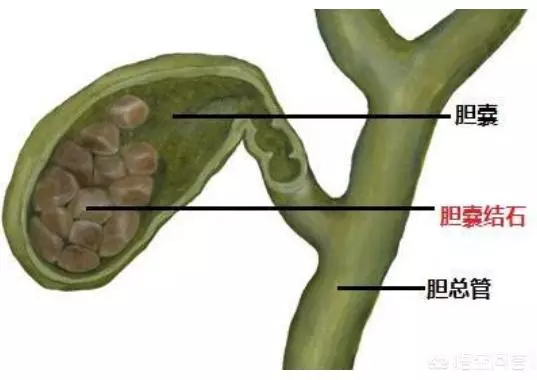 患膽囊炎的人能吃雞蛋嗎?醫生不建議吃蛋黃