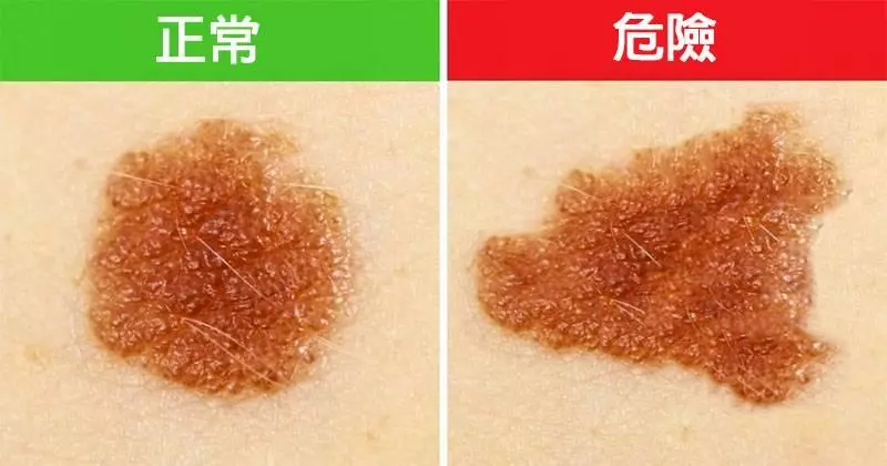 5種看起來正常但該馬上去看醫生的超危險「致命皮膚癌」異常胎記~~~~