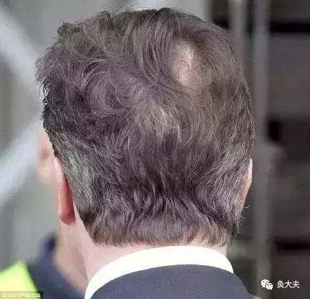 從頭髮一眼看出你腎臟的好壞,98%的人都說準!!