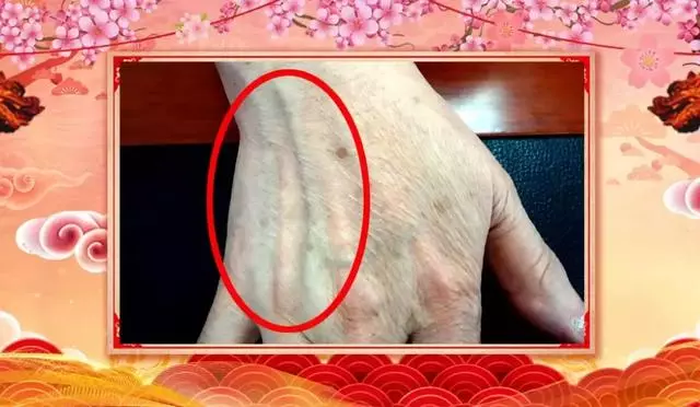 心臟狀況手上看出來!兩個方子通絡降脂、祛火潤燥,清除健康隱患