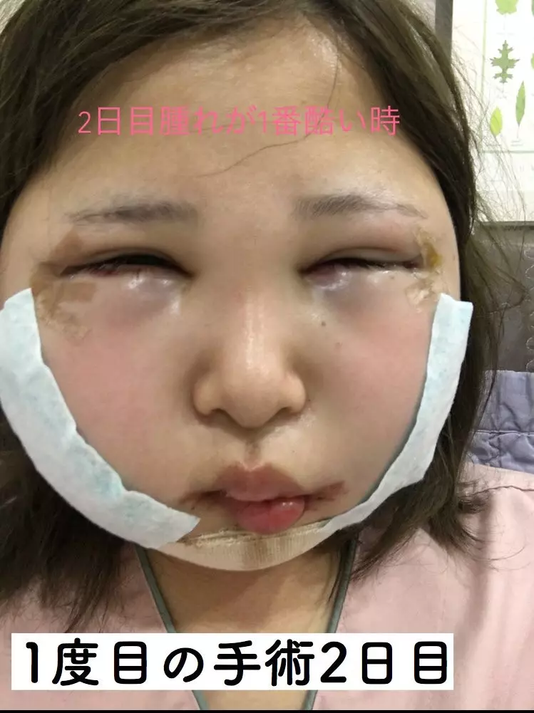 「你的樣子會為他人帶來不幸」 老爸一句話讓日本少女花400萬整形