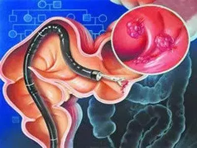 20歲小伙便血入院,查出直腸癌,醫生:這種「息肉」小心癌變