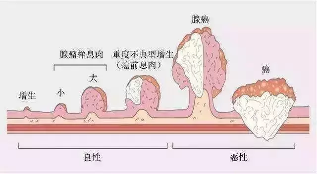 20歲小伙便血入院,查出直腸癌,醫生:這種「息肉」小心癌變