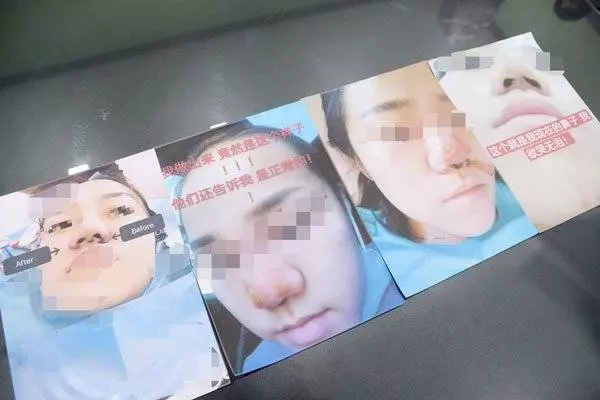 微信找上女醫生 吉隆坡少女整鼻整到塌