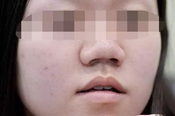 微信找上女醫生 吉隆坡少女整鼻整到塌
