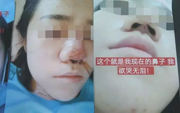 微信找上女醫生 吉隆坡少女整鼻整到塌