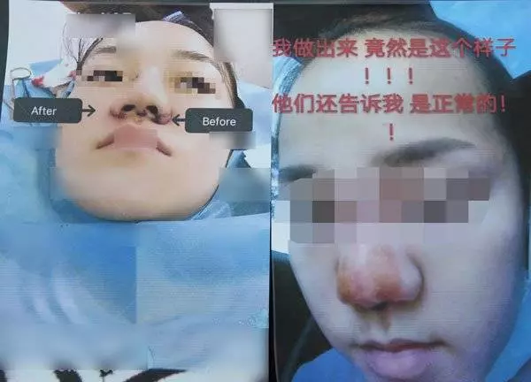 微信找上女醫生 吉隆坡少女整鼻整到塌