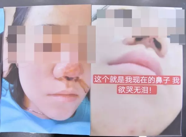 17歲少女耗資8500令吉隆鼻,自稱有10多年經驗的美容師就做成這樣?