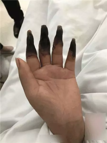 婦人打掃完家裡「8根指頭焦黑」慘變枯枝!連醫生也搖頭嘆:她太粗心了