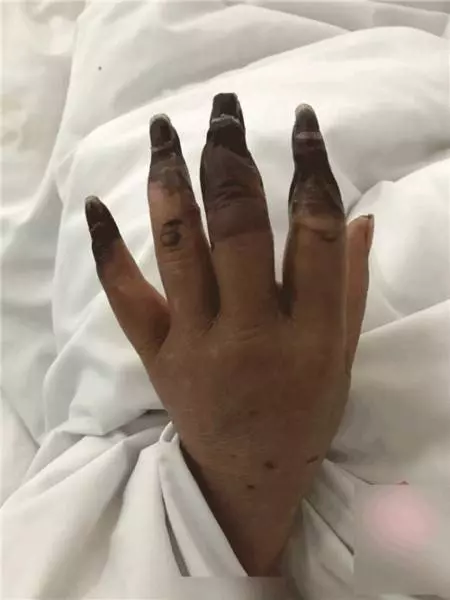 婦人打掃完家裡「8根指頭焦黑」慘變枯枝!連醫生也搖頭嘆:她太粗心了
