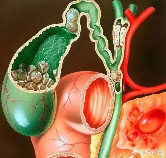 請問膽囊炎在生活中需要注意什麼? 勞累、心情、喝酒等是否會使膽囊炎嚴重呢