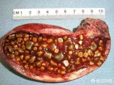 請問膽囊炎在生活中需要注意什麼? 勞累、心情、喝酒等是否會使膽囊炎嚴重呢