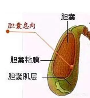 請問膽囊炎在生活中需要注意什麼? 勞累、心情、喝酒等是否會使膽囊炎嚴重呢