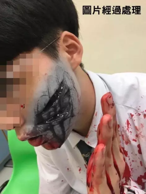 港仔大戰賓仔! 中三生被割傷臉
