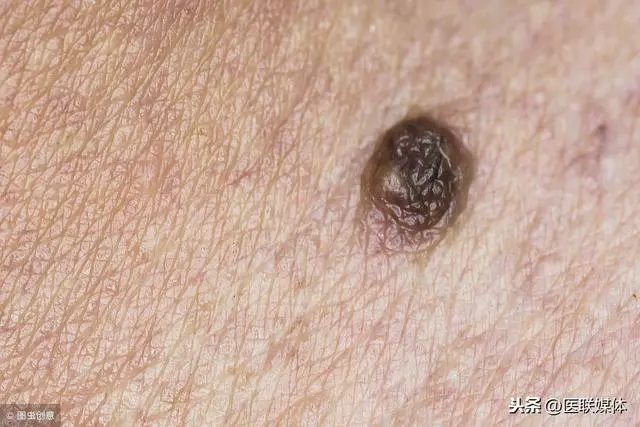 什麼樣的痣,可能是癌?出現這5種痣,得重點「監視」