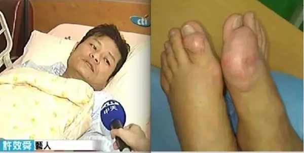 真的痛到崩潰了!藝人「許效舜」後台崩潰大哭,澎恰恰:讓他哭吧....!原來舜子早在幾年前就因為這種病癱軟掛急診....