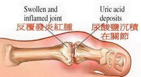 真的痛到崩潰了!藝人「許效舜」後台崩潰大哭,澎恰恰:讓他哭吧....!原來舜子早在幾年前就因為這種病癱軟掛急診....