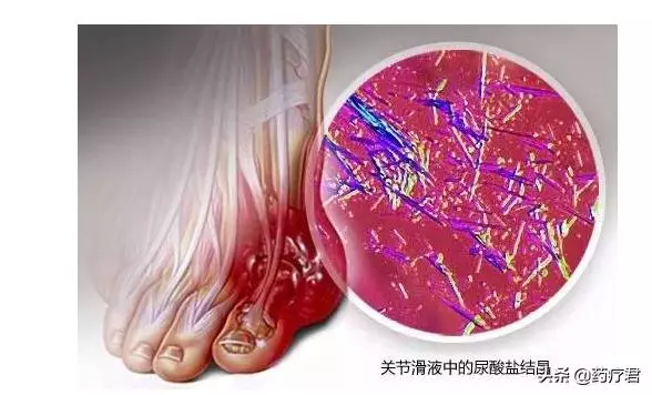 尿酸高,痛風沒發作就沒事?醫生:內臟更受傷!