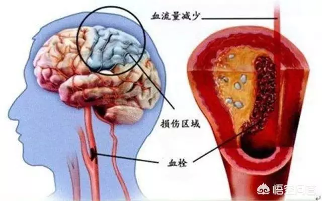 中風後,很多人反覆鍛鍊無效果,很多人又第二次中風是怎麼回事?中風沒幾個長壽的,為什麼?