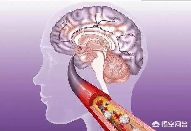 中風後,很多人反覆鍛鍊無效果,很多人又第二次中風是怎麼回事?中風沒幾個長壽的,為什麼?