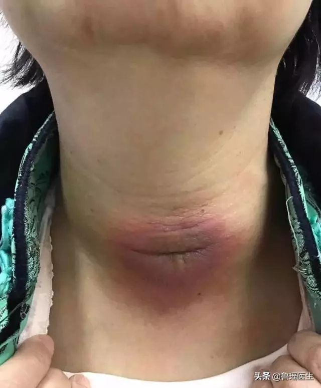 同樣是甲狀腺癌,為什麼生存時間不一樣?患者劉女士,61歲,脖子上皮膚紅腫,部分皮膚潰破