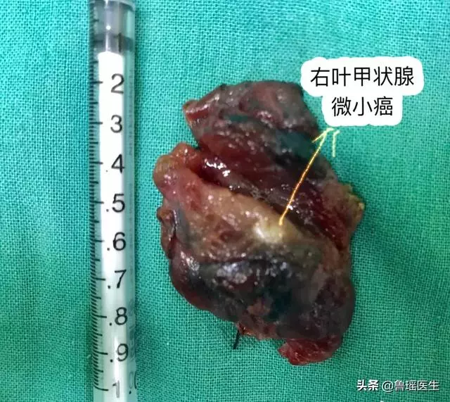 同樣是甲狀腺癌,為什麼生存時間不一樣?患者劉女士,61歲,脖子上皮膚紅腫,部分皮膚潰破