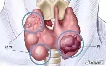 同樣是甲狀腺癌,為什麼生存時間不一樣?患者劉女士,61歲,脖子上皮膚紅腫,部分皮膚潰破