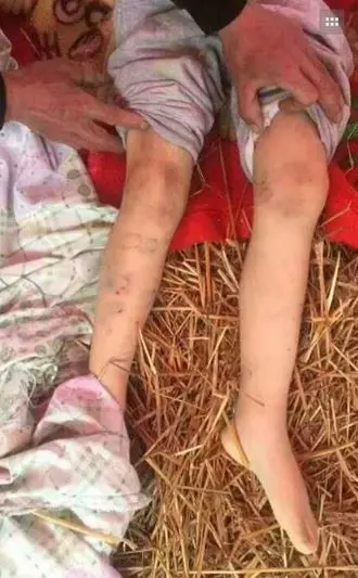 7歲女童被長期受虐!為躲狠母摔下樓梯慘死