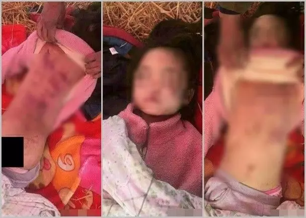 7歲女童被長期受虐 為躲狠母摔下樓梯慘死